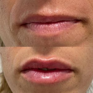 Clínica Dra. Joyssel Lopez Flores - Medicina Estética Facial | Aumento de labios